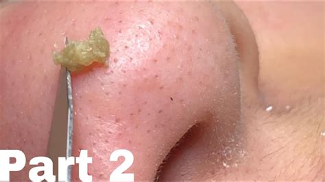 Pimple Popper 1. . Youtube new acne videos 2022 blackheads
